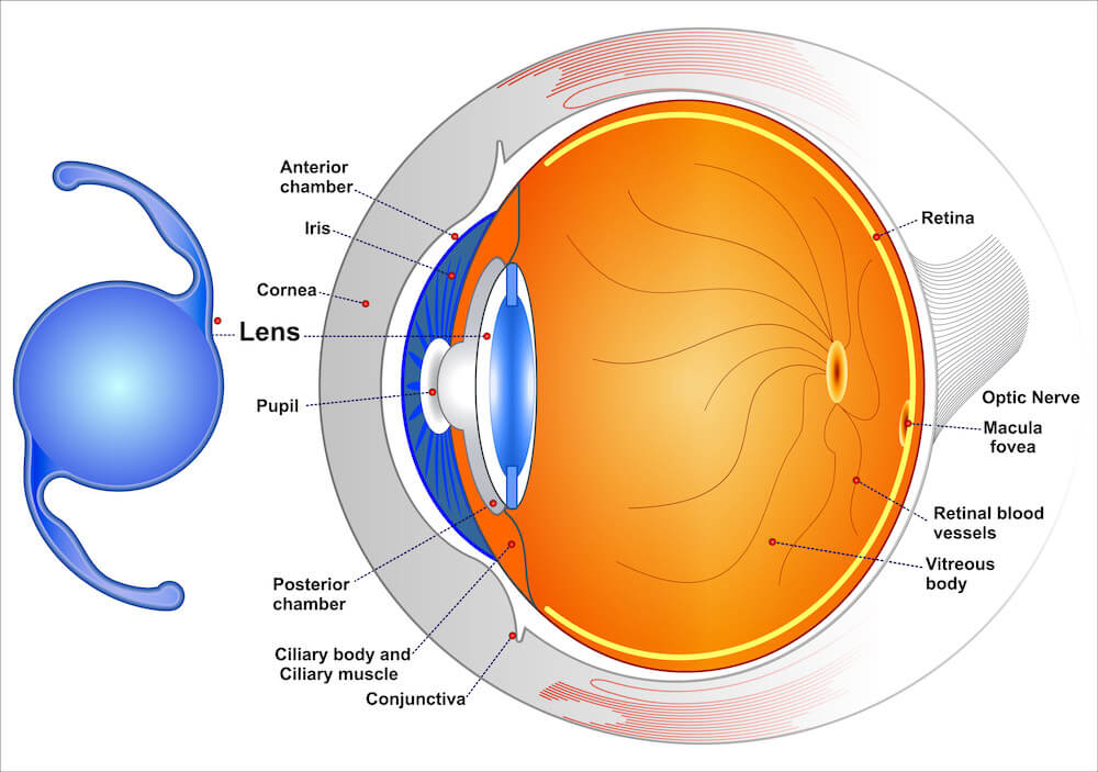 Diagram of how IOL works